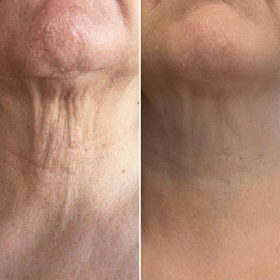 Rodillo 3D antiarrugas cuello y rostro
