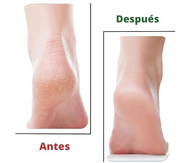 Quita cayos para pies suaves | Novarso