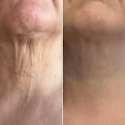 Rodillo 3D antiarrugas cuello y rostro