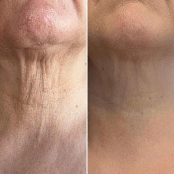 Rodillo 3D antiarrugas cuello y rostro